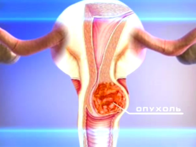 Онкология половых органов женщин и мужчин | Рак - лечение и ...
