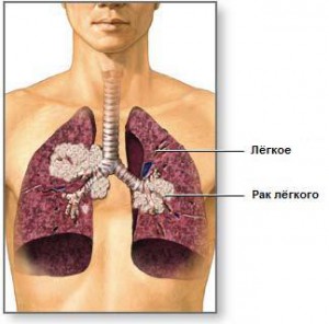 Рак легкого 4-й степени
