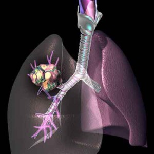 lung_cancer