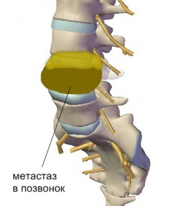 Метастазы в позвоночнике