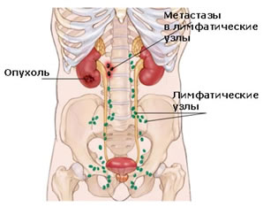 metastazyi