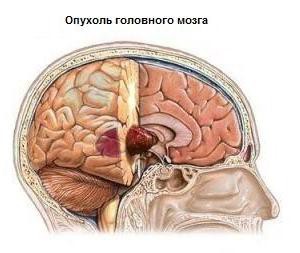 Опухоль головного мозга