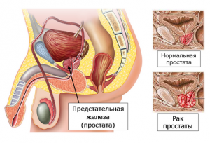 Рак простаты