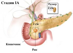 Рак поджелудочной железы. Стадия IА