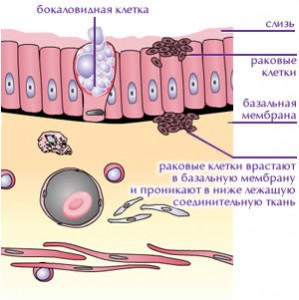 Рак легких