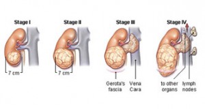 Стадии рака почек