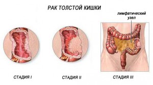 Стадии рака кишечника