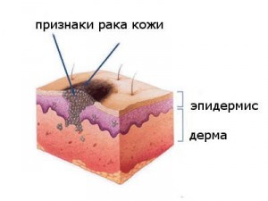 rak-kozhi-opredelenie