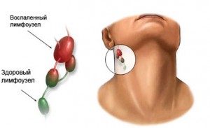 Увеличенные лимфоузлы
