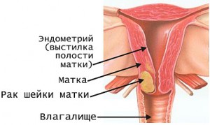 Рак шейки матки