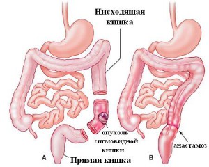 Опухоль сигмовидной кишки