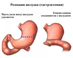 Удаление желудка при раке