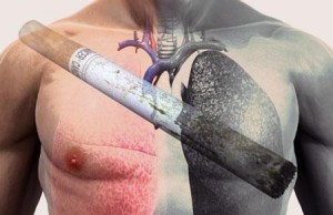Курение - причина возникновения рака легких