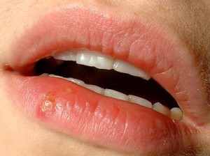 Первые симптомы рака губы