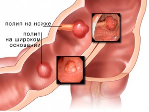 Рак прямой кишки. Виды