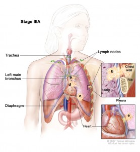 Рак легких. Стадия 3А