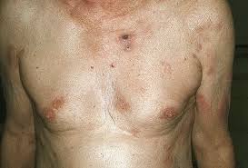 Т-клеточная лимфома кожи