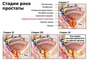 Стадии рака простаты