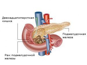 Рак поджелудочной железы