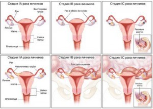 Стадии рака яичников