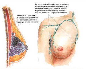 Распространение метастазов рака молочной железы