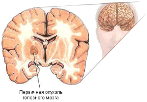 Опухоль головного мозга