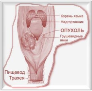 Рак гортани. Народное или консервативное лечение?