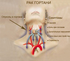 Симптомы рака гортани