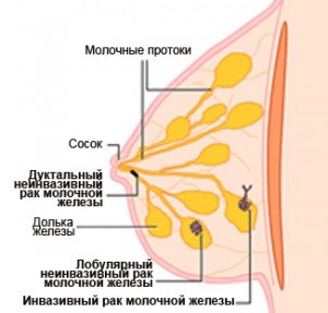 Возникновение рака груди