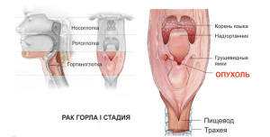 Рак гортани первая стадия