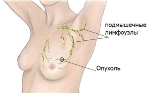 Рак груди. Нулевая стадия