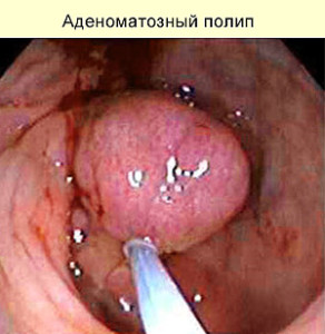 Аденоматозный полип