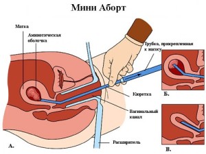 Повреждения матки при аборте