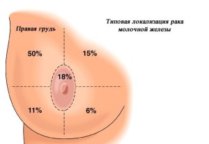 Локализация рака груди