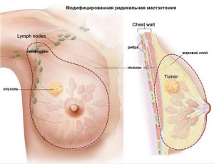 Мастэктомия