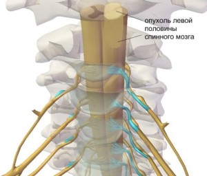 Рак позвоночника