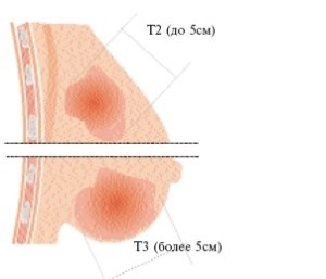 Карцинома молочной железы