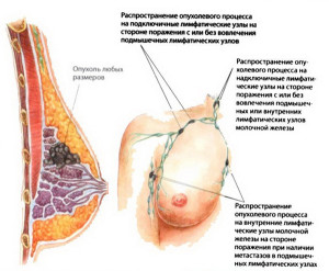 Рак груди и метастазы