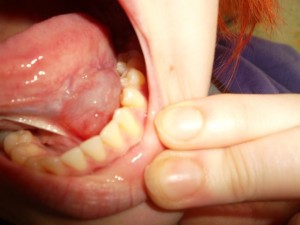 Опухоль под языком