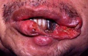 Рак губы четвертая стадия 