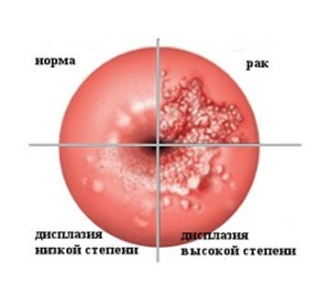 Рак шейки матки