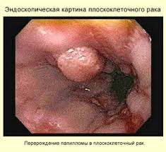 Плоскоклеточный рак гортани