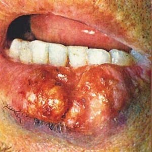 Рак губы 4я стадия