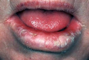 Рак губы