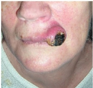 Экзофитный рак губы