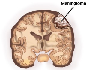 Менингиома