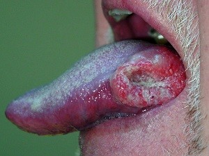 Запущенный рак языка