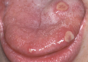 Опухоли на поверхности языка