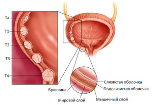Рак мочевого пузыря
