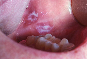 Признаки рака слизистой рта